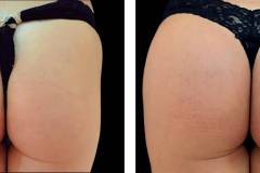 bioplastia-de-gluteos-antes-e-depois-clinica-leger-10 bioplastia-de-gluteos-antes-e-depois-clinica-leger-10
