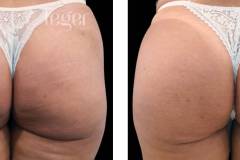 bioplastia-de-gluteos-antes-e-depois-clinica-leger-3 bioplastia-de-gluteos-antes-e-depois-clinica-leger-3