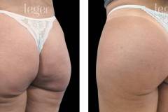 bioplastia-de-gluteos-antes-e-depois-clinica-leger-4 bioplastia-de-gluteos-antes-e-depois-clinica-leger-4