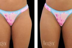 bioplastia-de-gluteos-antes-e-depois-clinica-leger-5 bioplastia-de-gluteos-antes-e-depois-clinica-leger-5