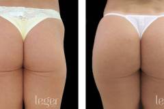 bioplastia-de-gluteos-antes-e-depois-clinica-leger-6 bioplastia-de-gluteos-antes-e-depois-clinica-leger-6