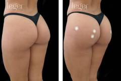 bioplastia-de-gluteos-antes-e-depois-clinica-leger-7 bioplastia-de-gluteos-antes-e-depois-clinica-leger-7