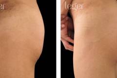 bioplastia-de-gluteos-antes-e-depois-clinica-leger-8 bioplastia-de-gluteos-antes-e-depois-clinica-leger-8
