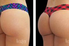 bioplastia-de-gluteos-antes-e-depois-clinica-leger-9 bioplastia-de-gluteos-antes-e-depois-clinica-leger-9