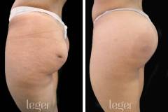 bioplastia-de-gluteos-antes-e-depois-clinica-leger bioplastia-de-gluteos-antes-e-depois-clinica-leger