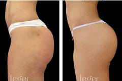 bioplastia-de-nariz-antes-e-depois-clinica-leger1 bioplastia-de-nariz-antes-e-depois-clinica-leger1